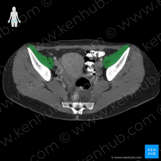 Musculus iliopsoas (Darmbein-Lenden-Muskel); Bild: 