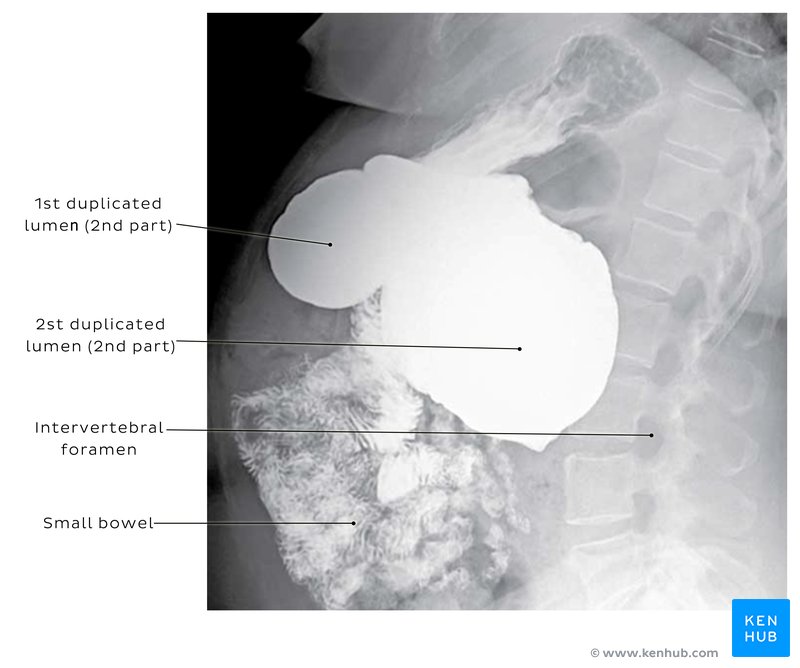 Gastrointestinal radiography - lateral view