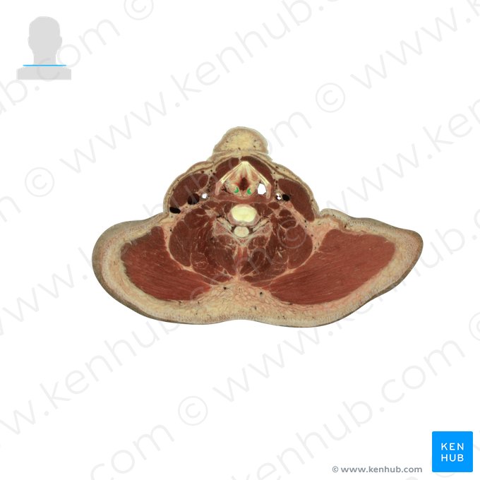 Arytenoid cartilage (Cartilago arytenoidea); Image: National Library of Medicine