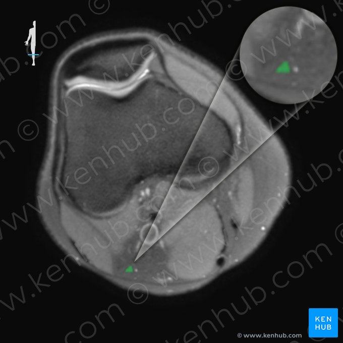 Nervio fibular común (Nervus fibularis communis); Imagen: 