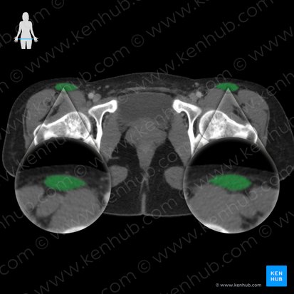 Músculo sartório (Musculus sartorius); Imagem: 