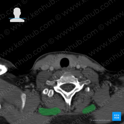 Músculo romboides menor (Musculus rhomboideus minor); Imagen: 