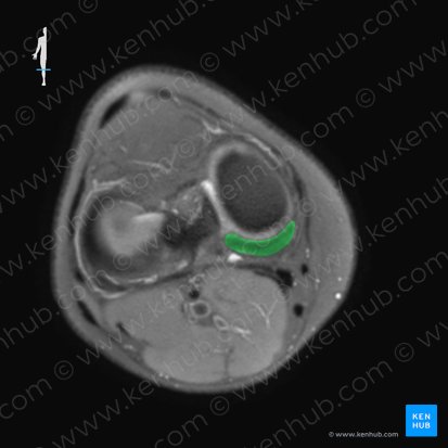 Medial meniscus (Meniscus medialis); Image: 