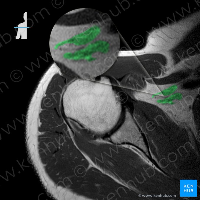 Brachial plexus (Plexus brachialis); Image: 