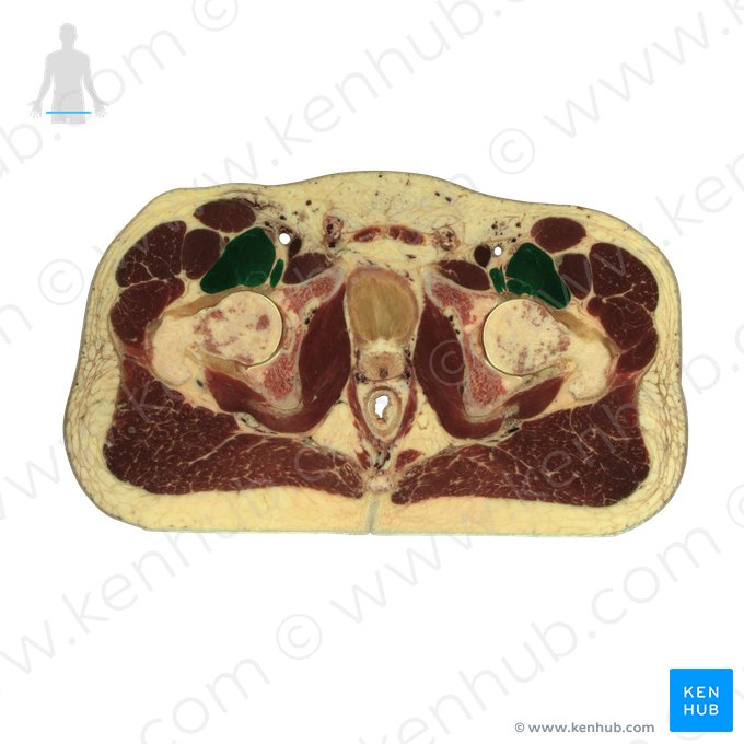 Iliopsoas muscle (Musculus iliopsoas); Image: National Library of Medicine