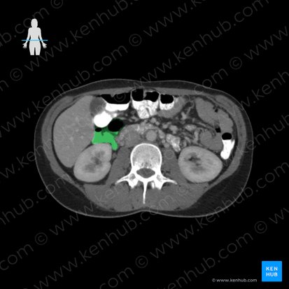 Colon ascendente (Colon ascendens); Imagen: 