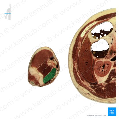 Pronator teres muscle (Musculus pronator teres); Image: National Library of Medicine