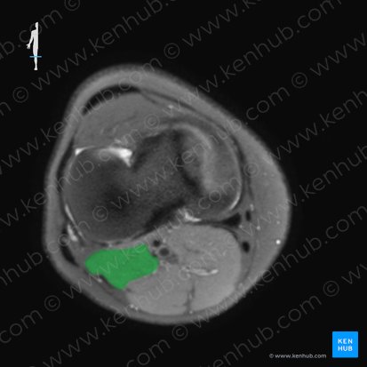 Plantaris muscle (Musculus plantaris); Image: 