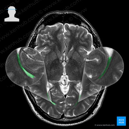 Occipital horn of lateral ventricle (Cornu occipitale ventriculi lateralis); Image: 