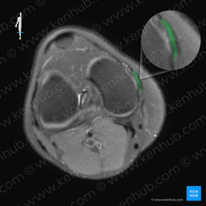 Ligamentum collaterale tibiale genus (Inneres Kollateralband des Kniegelenks); Bild: 