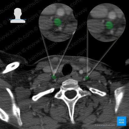 Vertebral vein (Vena vertebralis); Image: 