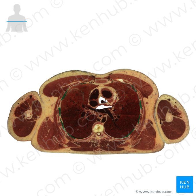 Musculi intercostales interni (Innere Zwischenrippenmuskeln); Bild: National Library of Medicine