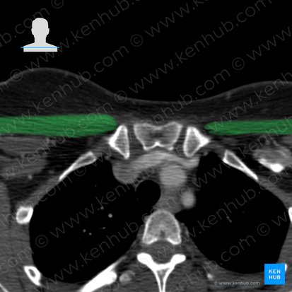 Músculo pectoral mayor (Musculus pectoralis major); Imagen: 