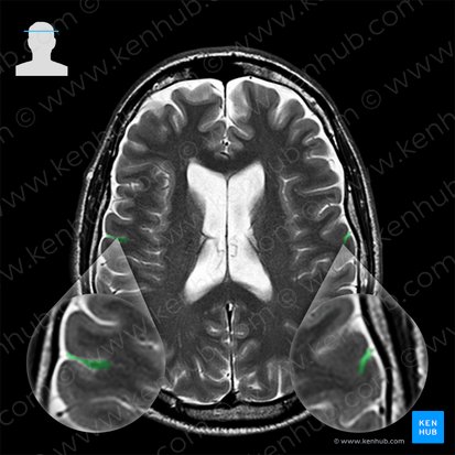 Surco central (Sulcus centralis); Imagen: 