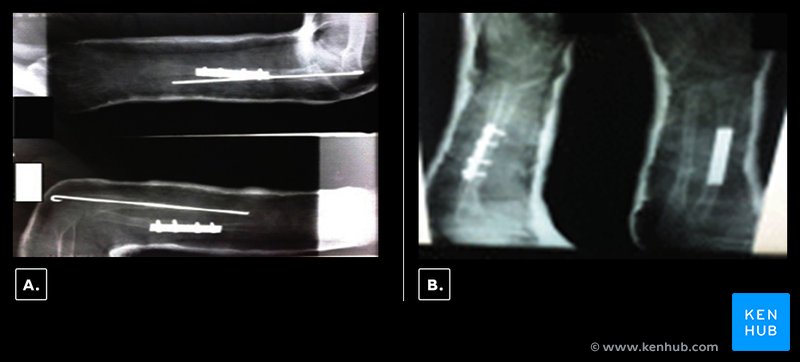 Postoperative radiograph