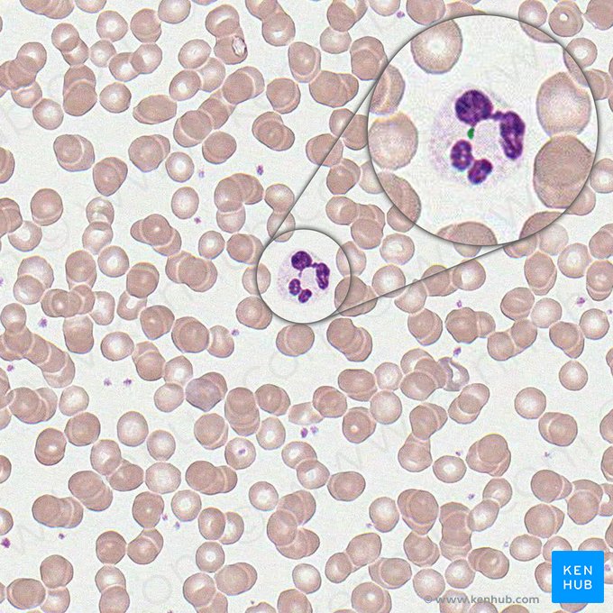 Cromatina sexual de neutrófilo (Chromatinum sexuale neutrophili); Imagem: 