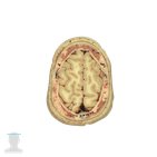 Superior sagittal sinus level