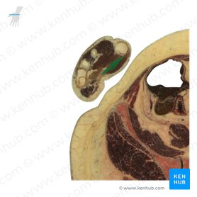 Musculus flexor pollicis brevis (Kurzer Daumenbeuger); Bild: National Library of Medicine