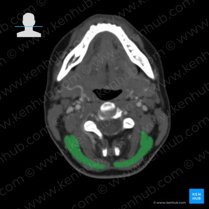 Splenius capitis muscle (Musculus splenius capitis); Image: 