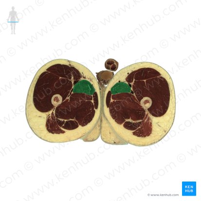 Musculus adductor longus (Langer Oberschenkelanzieher); Bild: National Library of Medicine