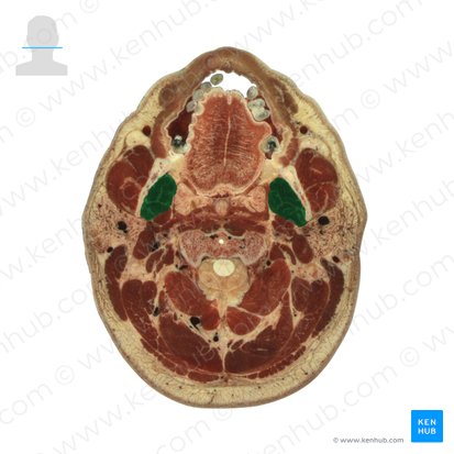 Medial pterygoid muscle (Musculus pterygoideus medialis); Image: National Library of Medicine