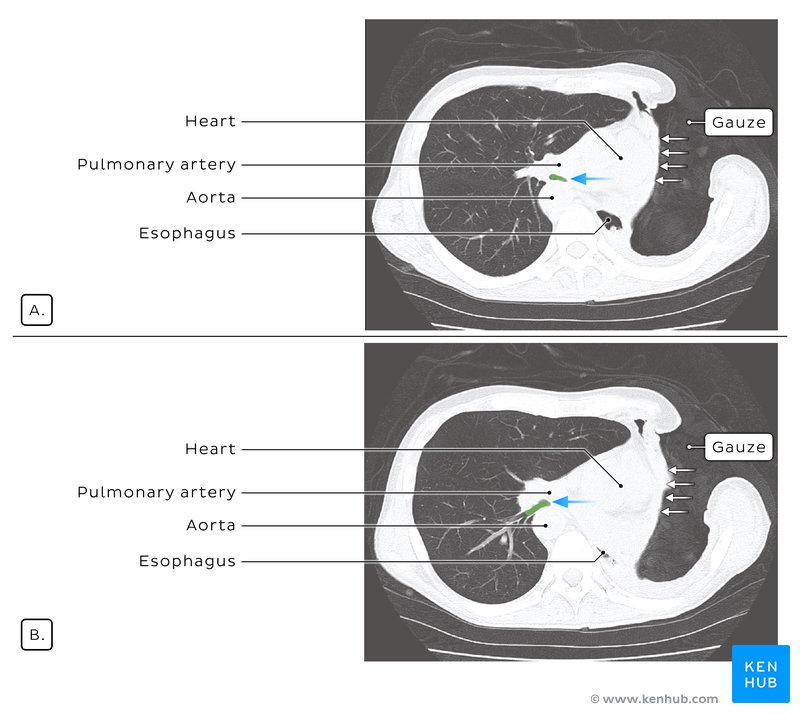 Surgical repositioning of the mediastinum using gauze - axial CT