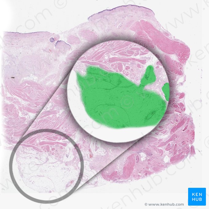 Perivesical fat; Image: 