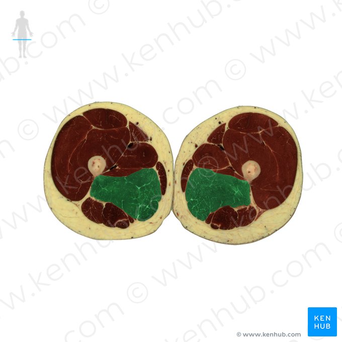 Músculo adutor magno (Musculus adductor magnus); Imagem: National Library of Medicine