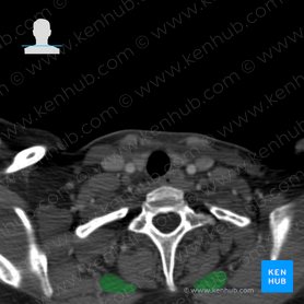 Rhomboids: Origin, insertion, innervation and function | Kenhub