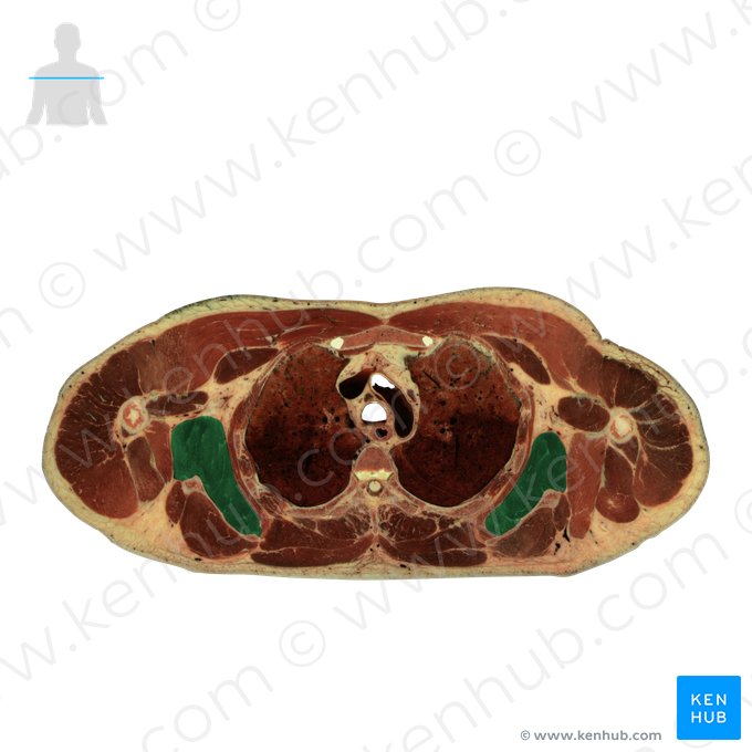 Subscapularis muscle (Musculus subscapularis); Image: National Library of Medicine