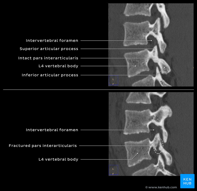 Intact and fractured L4 pars interarticularis - sagittal view