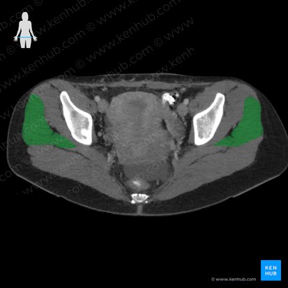 Músculo glúteo médio (Musculus gluteus medius); Imagem: 