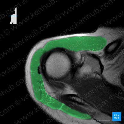 Muscle deltoïde (Musculus deltoideus); Image : 