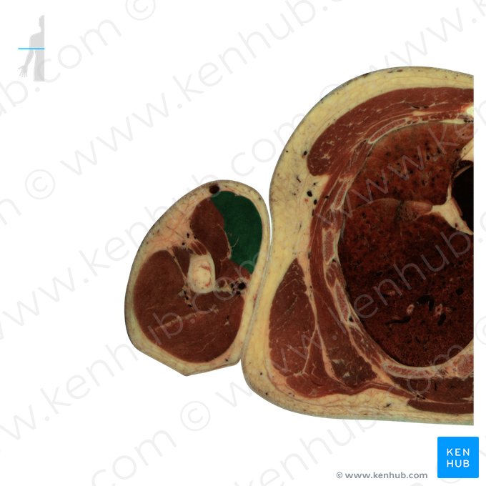 Cabeça curta do músculo bíceps braquial (Caput breve musculi bicipitis brachii); Imagem: National Library of Medicine