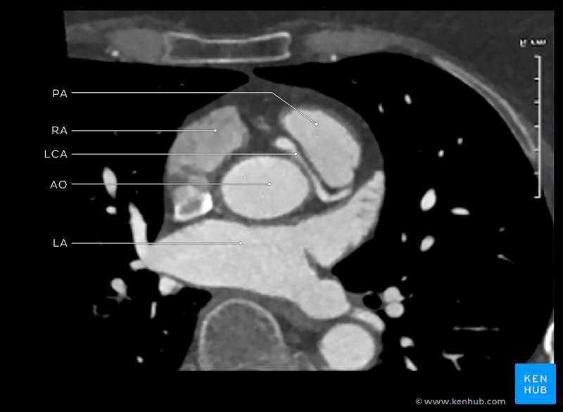 Left main coronary artery anomaly - axial CT