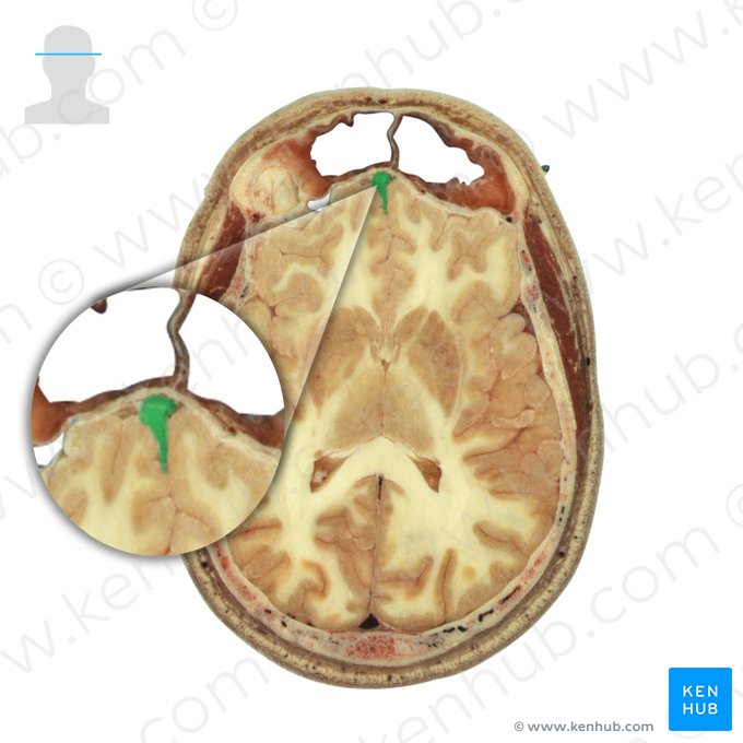 Crista etmoidal (Crista galli ossis ethmoidalis); Imagem: National Library of Medicine