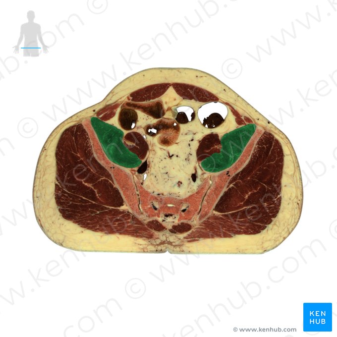 Iliacus muscle (Musculus iliacus); Image: National Library of Medicine