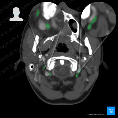 Suboccipital venous plexus (Plexus venosus suboccipitalis); Image: 