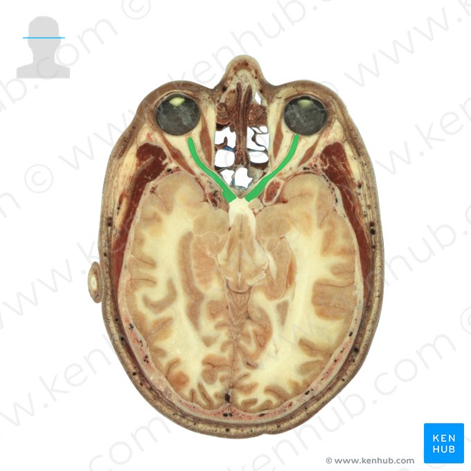 Optic nerve (Nervus opticus); Image: National Library of Medicine