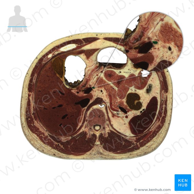 Arteria hepatica communis (Gemeinsame Leberarterie); Bild: National Library of Medicine