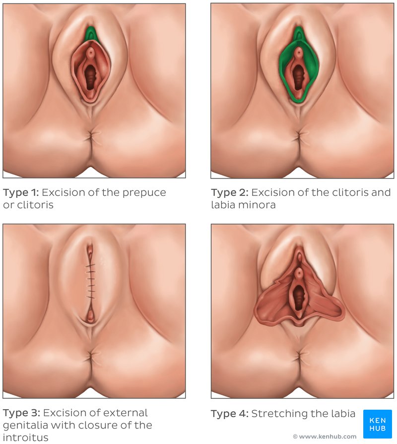 Female Genital Mutilation - Classification