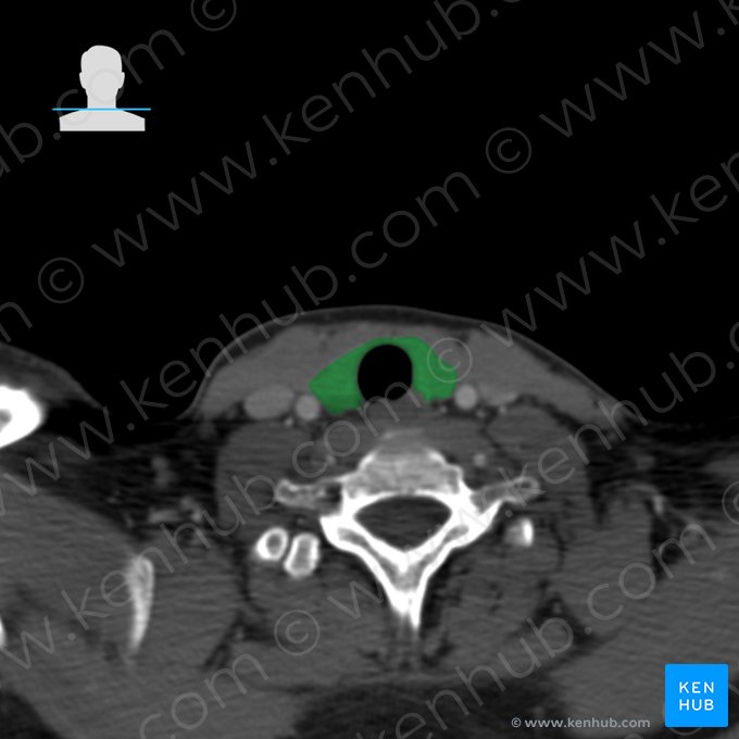 Glândula tireoide (Glandula thyroidea); Imagem: 