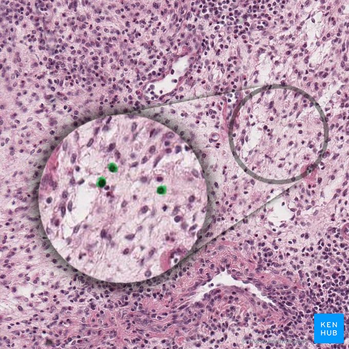 Linfocito (Lymphocytus); Imagen: 