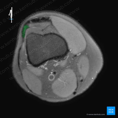 Tendón del músculo vasto lateral (Tendo musculi vasti lateralis); Imagen: 