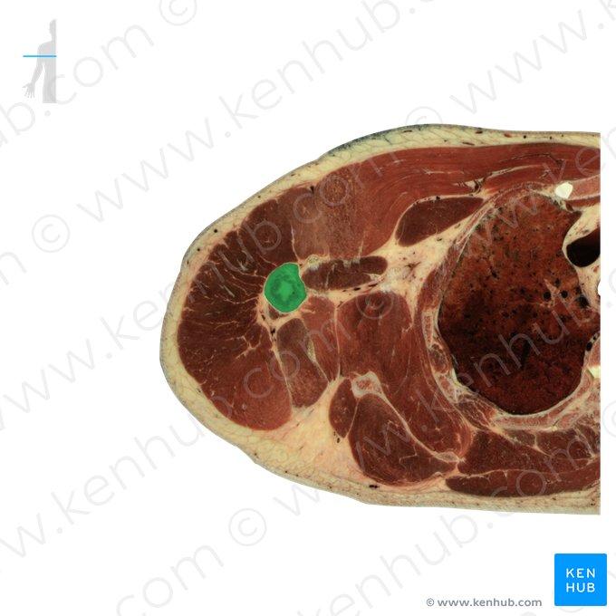 Humerus (Oberarmknochen); Bild: National Library of Medicine