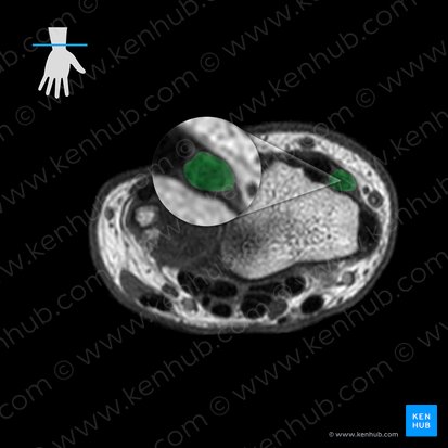 Tendon of extensor carpi radialis longus muscle (Tendo musculi extensoris carpi radialis longi); Image: 