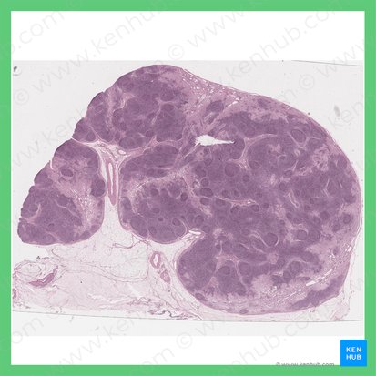 Ganglio linfático reactivo (Nodus lymphoideus reactivus); Imagen: 