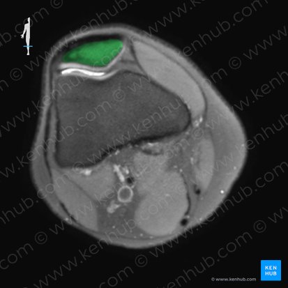 Patella (Kniescheibe); Bild: 