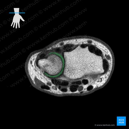 Discus articulationis radioulnaris distalis (Gelenkscheibe des distalen Radioulnargelenks); Bild: 