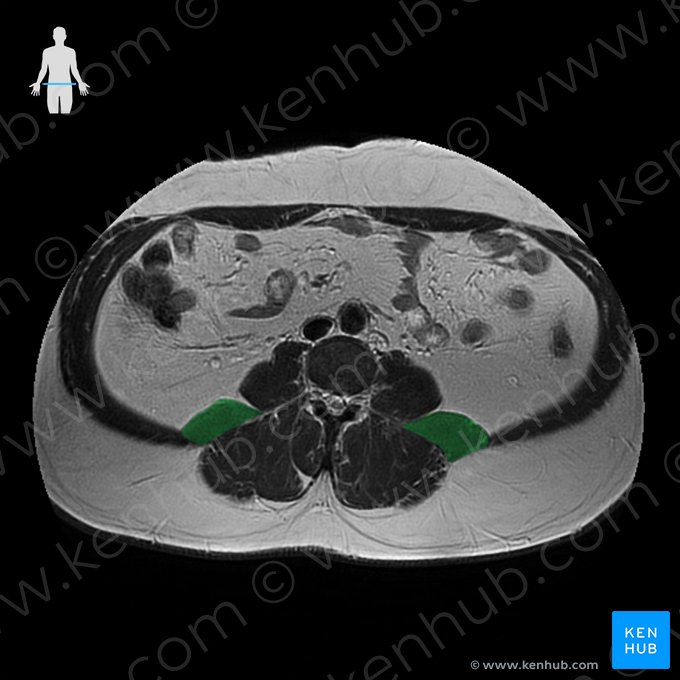 Musculus quadratus lumborum (Viereckiger Lendenmuskel); Bild: 